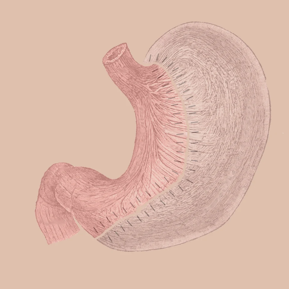 Sleeve gastrectomy changes the stomach into a narrow tube; this is a procedure schematic.